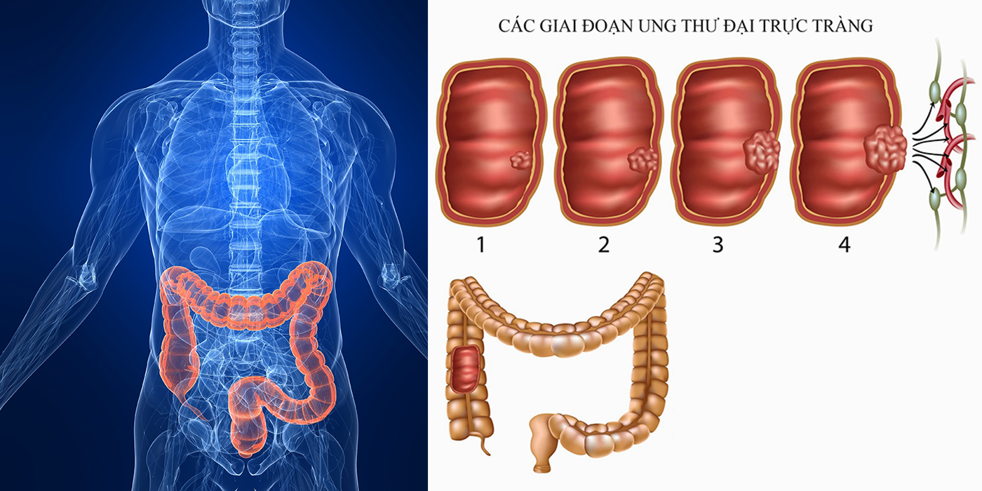 Ung thư đại trực trạng là bệnh thường gặp ở cả nam và nữ