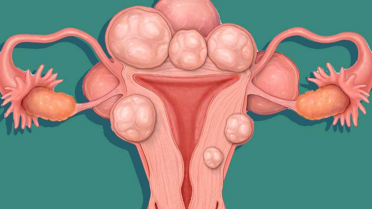 U xơ cổ tử cung là bệnh phụ khoa thường gặp ở phụ nữ