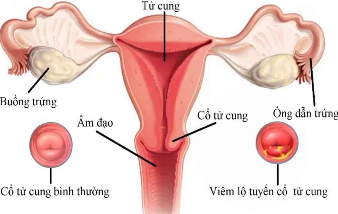 Viêm lộ tuyến cổ tử cung là bệnh phổ biến ở phụ nữ